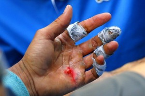 Nadal Federer left hand injury